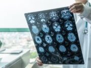 ASTUCE Spain demana reforçar els assaigs clínics en oligodendroglioma